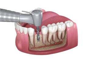 root canal pinellas