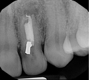 Endodontist in St. Petersburg