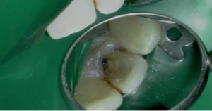 Endodontist in St. Petersburg