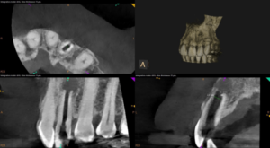 Endodontist in St. Petersburg