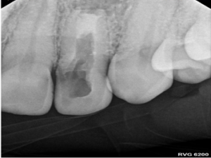 Endodontist in St. Petersburg