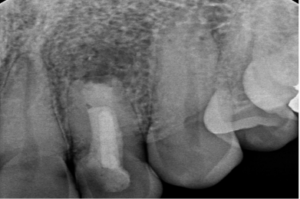 Endodontist in St. Petersburg