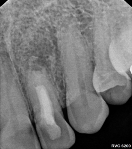 Endodontist in St. Petersburg