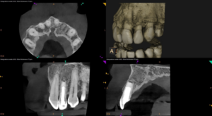 Endodontist in St. Petersburg