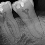 Post-treatment X-ray root canal therapy and surgical repair of tooth