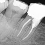 X-ray showing bilaterally symmetric root resorption