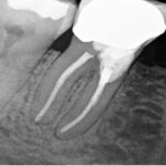 x-ray of root canal treatment in St. Petersburg, FL
