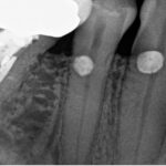 x-ray of root canal treatment in St. Petersburg, FL