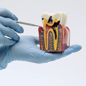 Endodontist in St. Petersburg