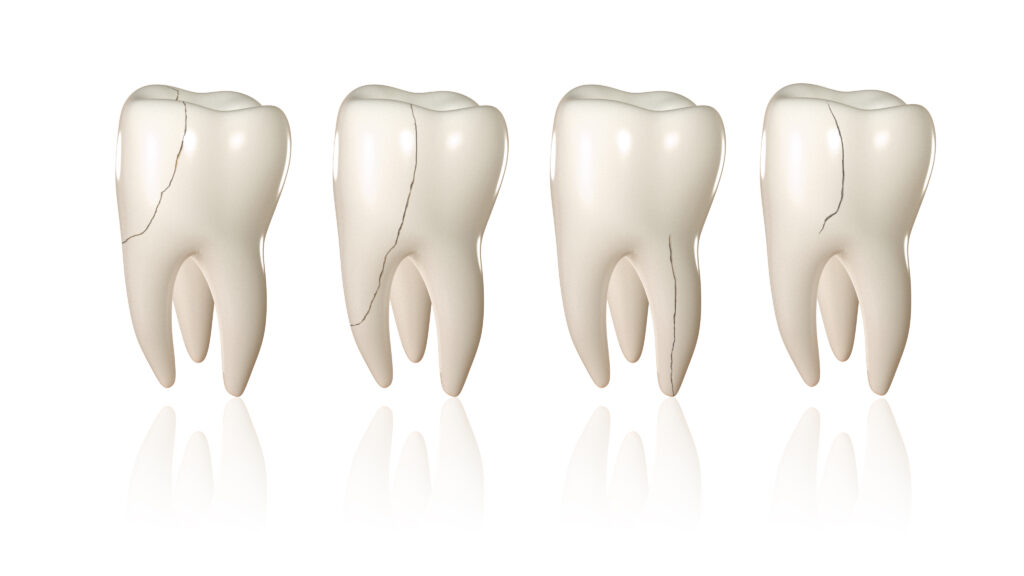 cracked tooth treatment St. Petersburg, FL