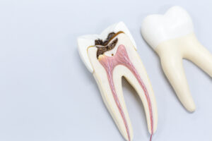 Endodontist in St. Petersburg