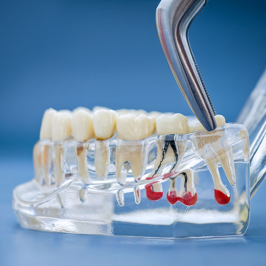 Endodontist in St. Petersburg