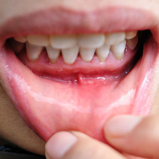 Endodontist in St. Petersburg